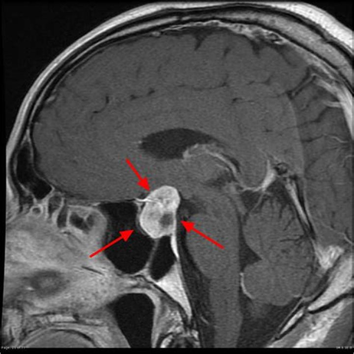 Can a pituitary tumor affect sleep?