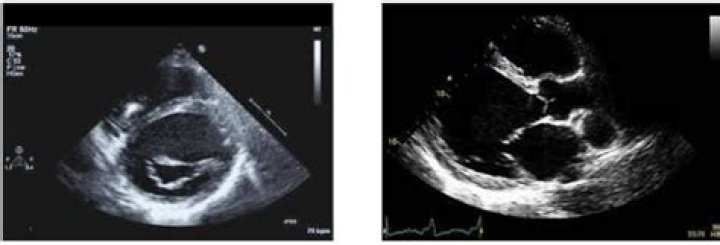 Can cardiomyopathy be seen on Echo?