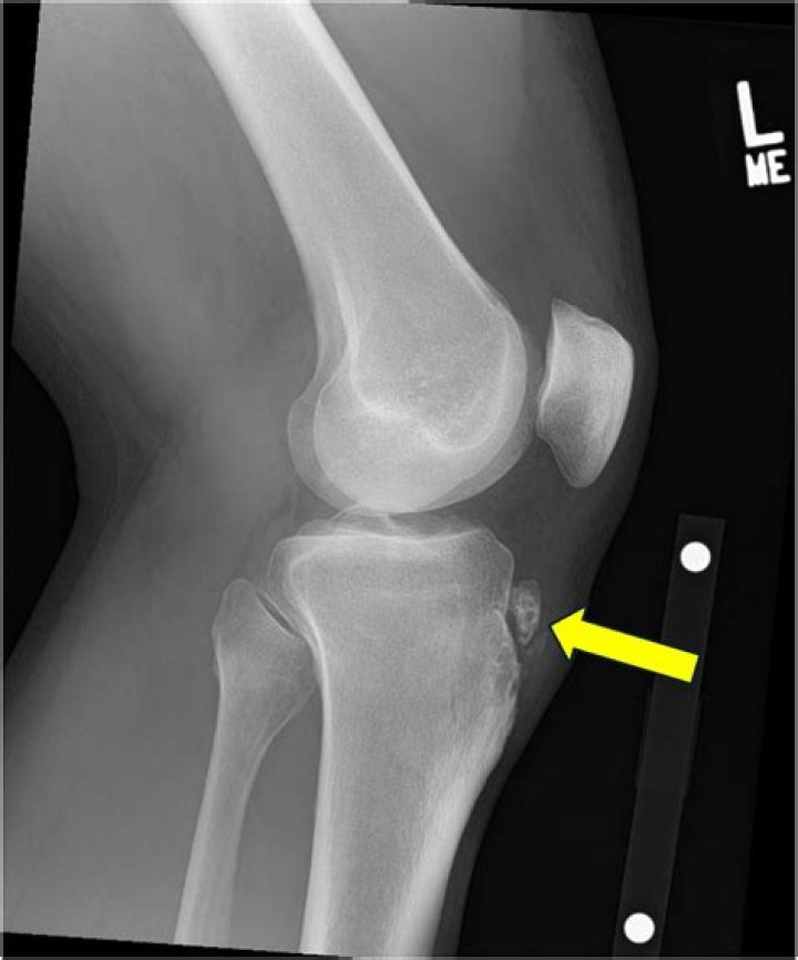 Can Osgood Schlatter be cured with surgery?