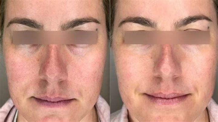 Can you use cryotherapy on lips?