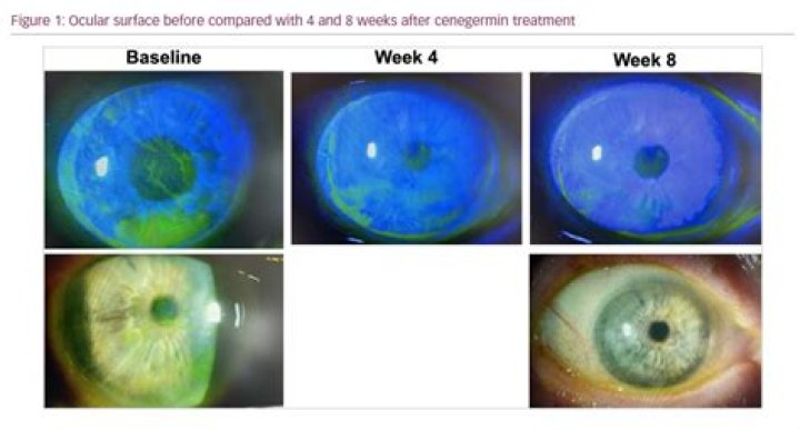 How can keratitis be treated?