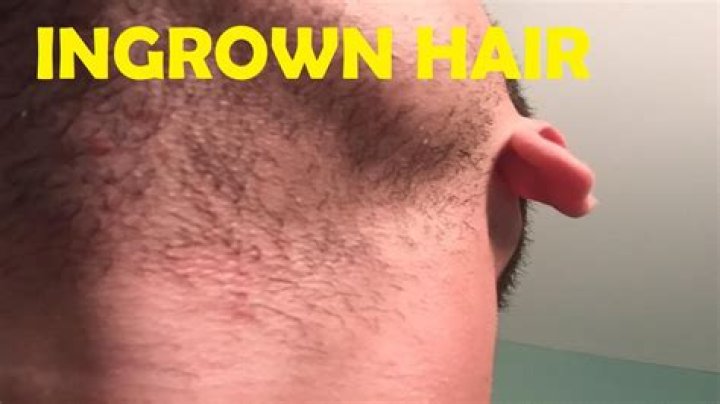 How do you get rid of ingrown hairs after shaving your face?