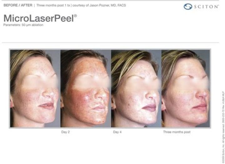 Is micro laser peel safe?