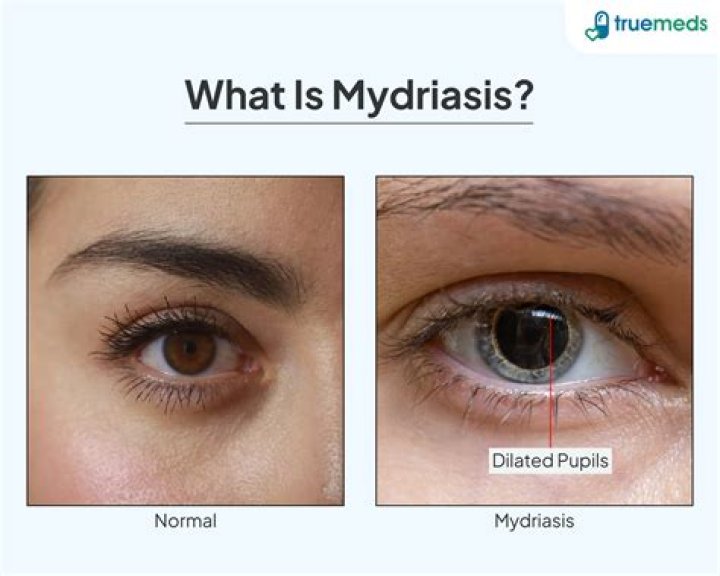 Is Traumatic mydriasis permanent?