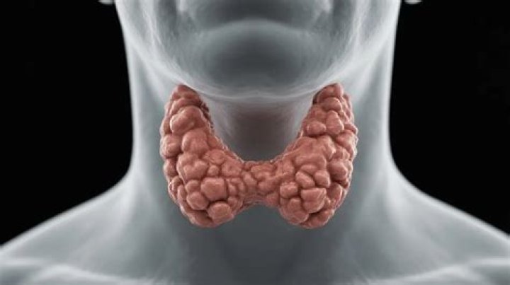 Should a multinodular goiter be removed?
