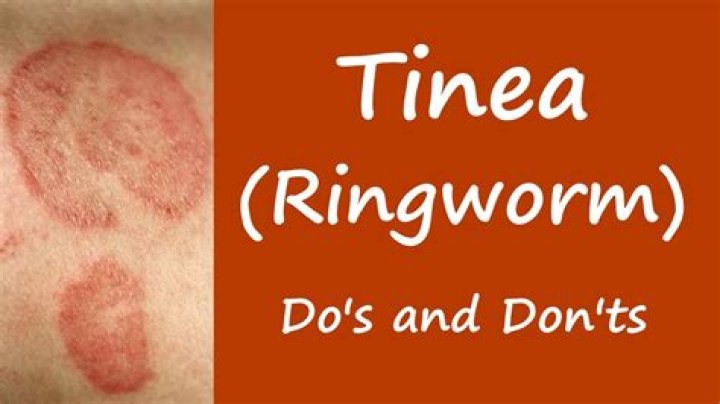 What causes ringworm on the skin?
