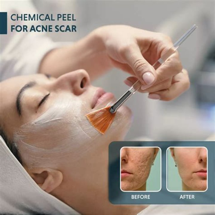 What drugstore removes acne scars?