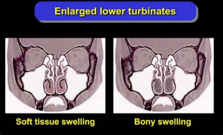 What is a bilateral Turbinectomy?