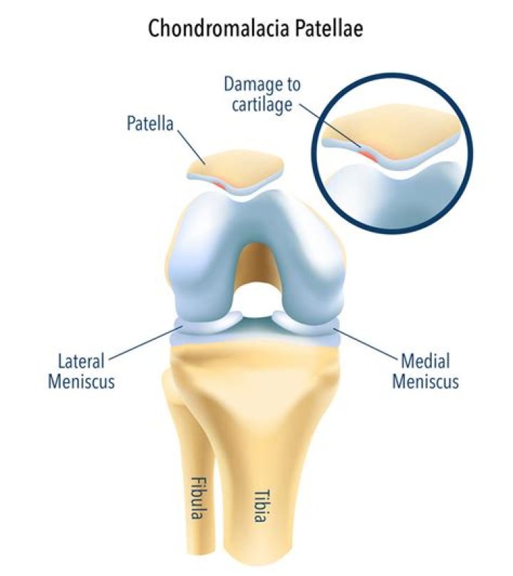 What is an open patella?
