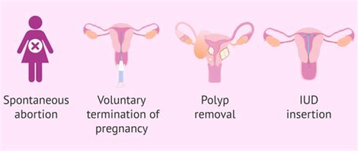 What is curettage pregnancy?
