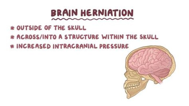 What is herniation of the meninges called?