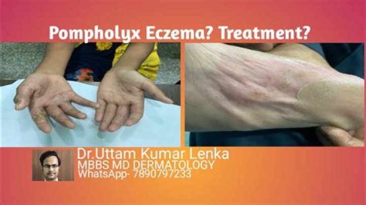 What is the best treatment for Pompholyx?