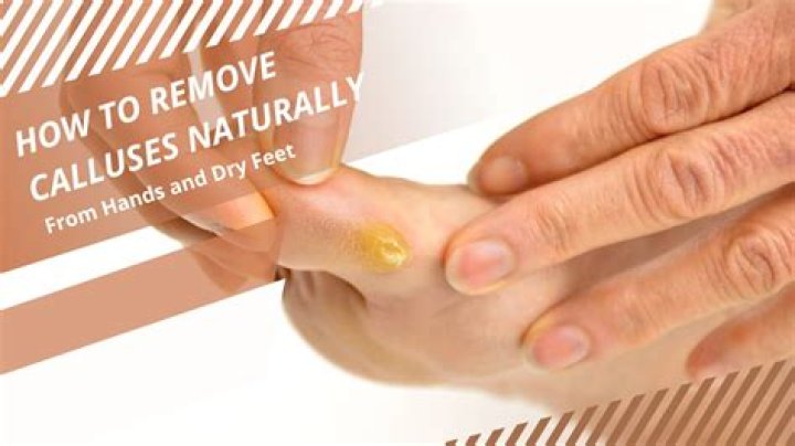 What is the best way to remove calluses?