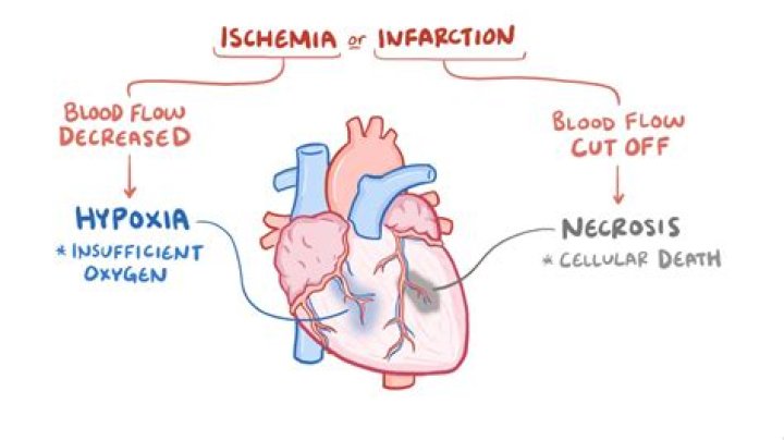 What is the most common cause of myocardial ischemia?