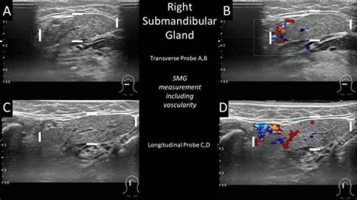 What is the normal size of submandibular gland?