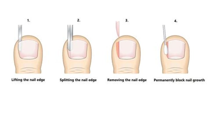 What should I do after ingrown toenail surgery?