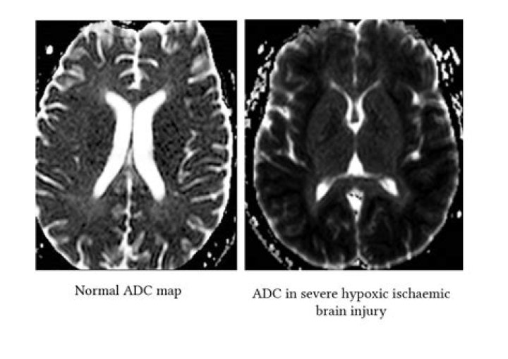 Which is the most severe consequence of hypoxic ischemic encephalopathy?